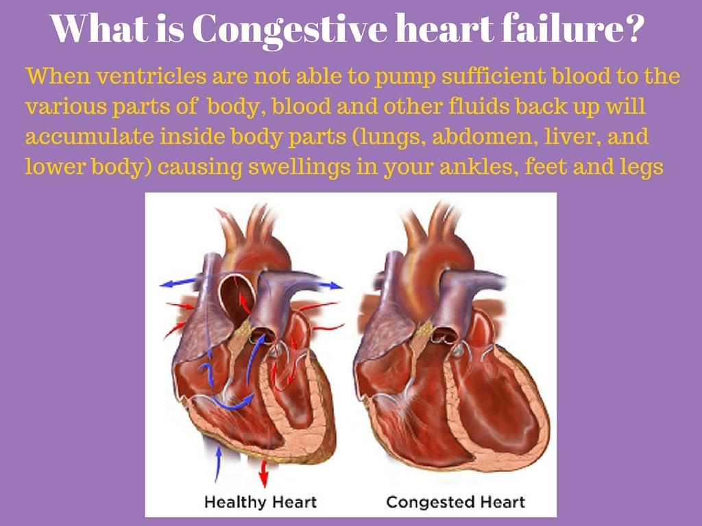 Congestive Heart Failure Animated Gifs | Photobucket