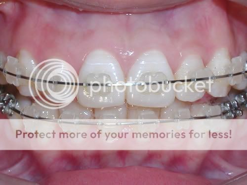 Dental A22 Orthodontics Roth Ceramic Bracket Braces  